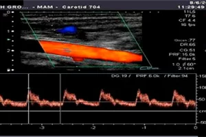 УЗДГ сосудов шеи и головы на экране