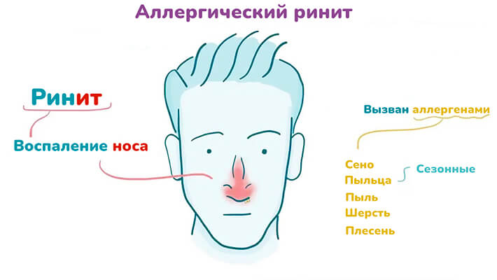 Риносинусит (гайморит)