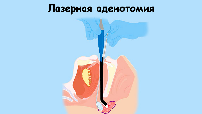 Хронический тонзиллит и гиперплазия миндалин.