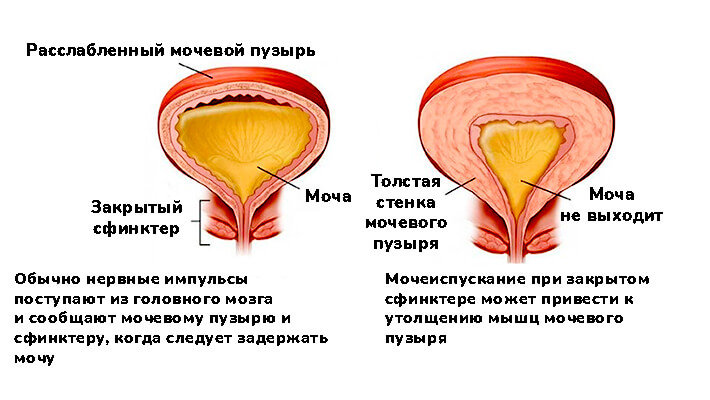 С чем связано частое мочеиспускание у женщин и как это лечится