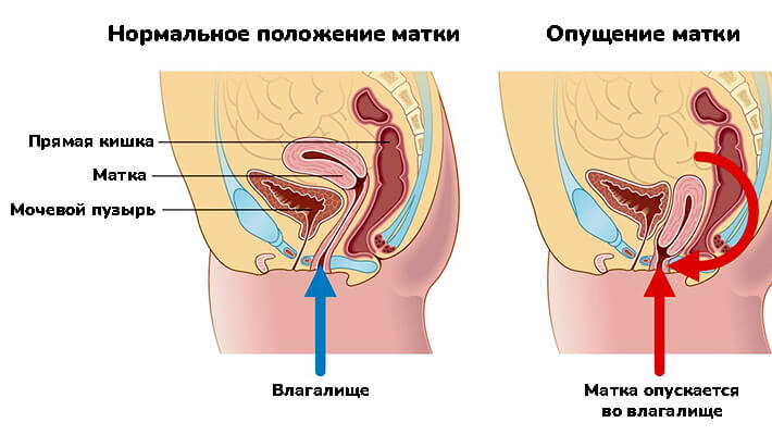 Опущение матки