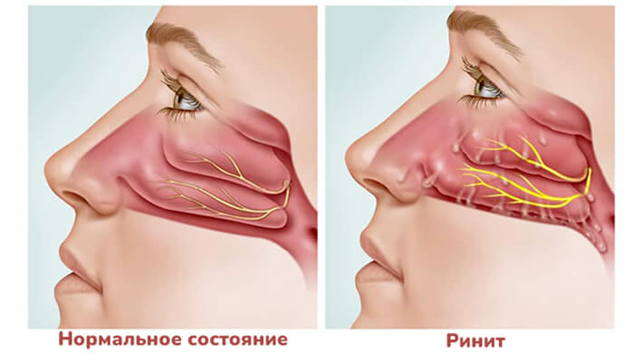 Что такое хронический ринит и как его лечить у взрослых