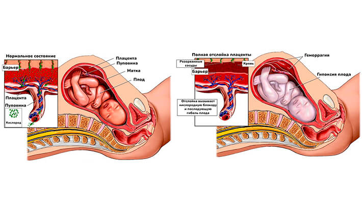 Гипоксия плода - признаки, причины, диагностика и профилактика