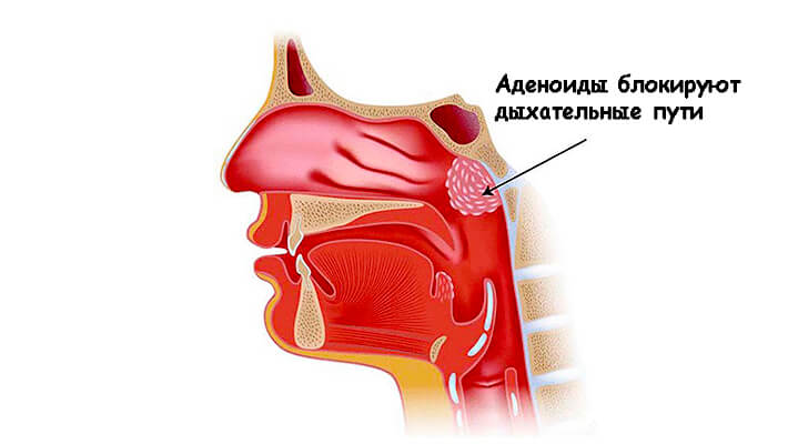 Что такое аденоиды и как их лечить?
