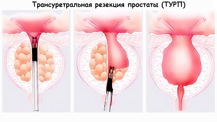 Трансуретральная резекция (ТУР) предстательной железы