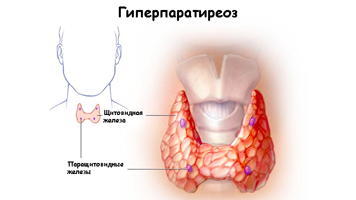 Гиперпаратиреоз